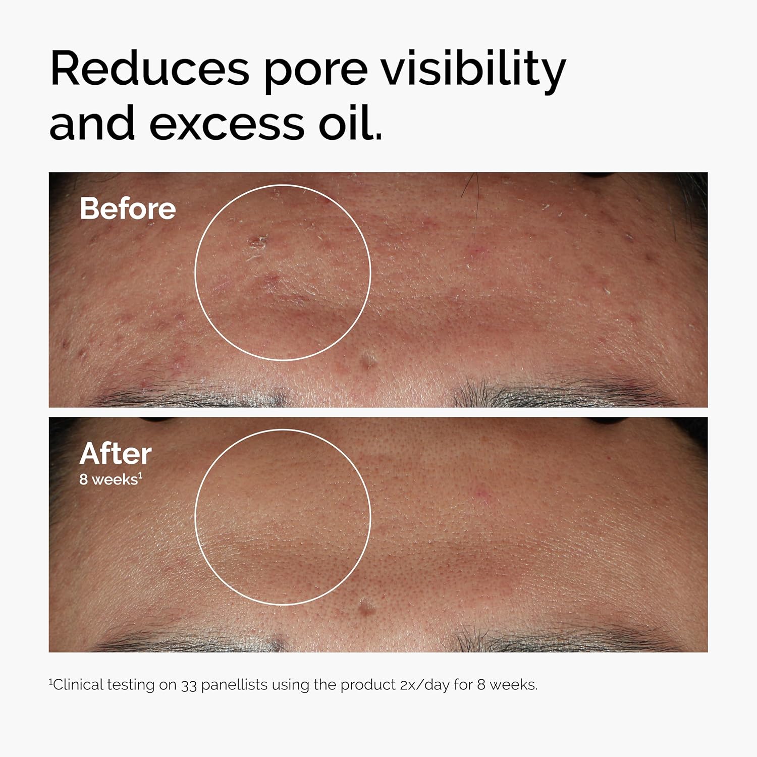 ✨ Niacinamide 10% + Zinc 1% Clarifying Face Serum 💧🔥[Limited time offer]