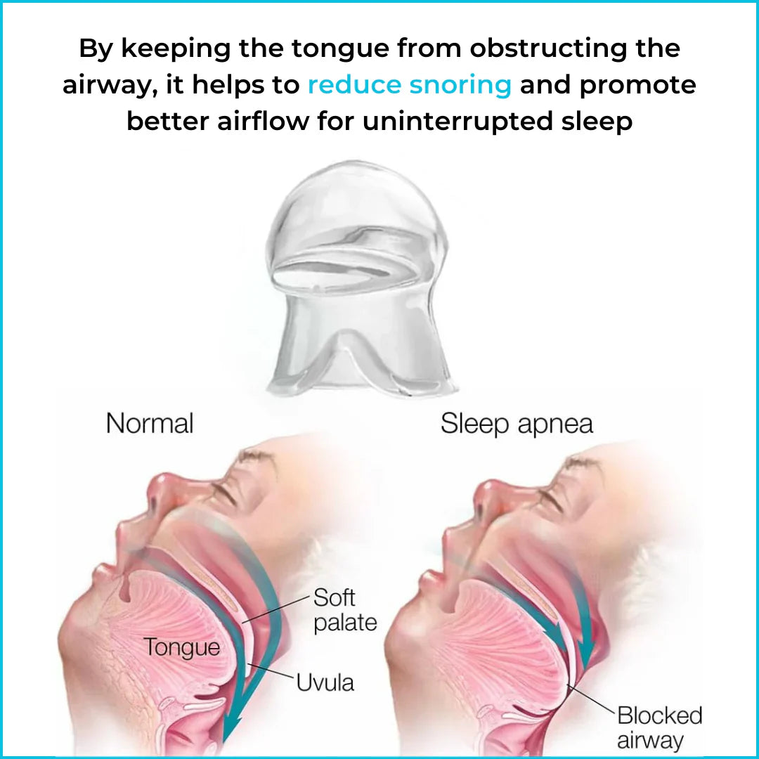 [Official Store]JEREMYTIS™ - Anti Snoring Device