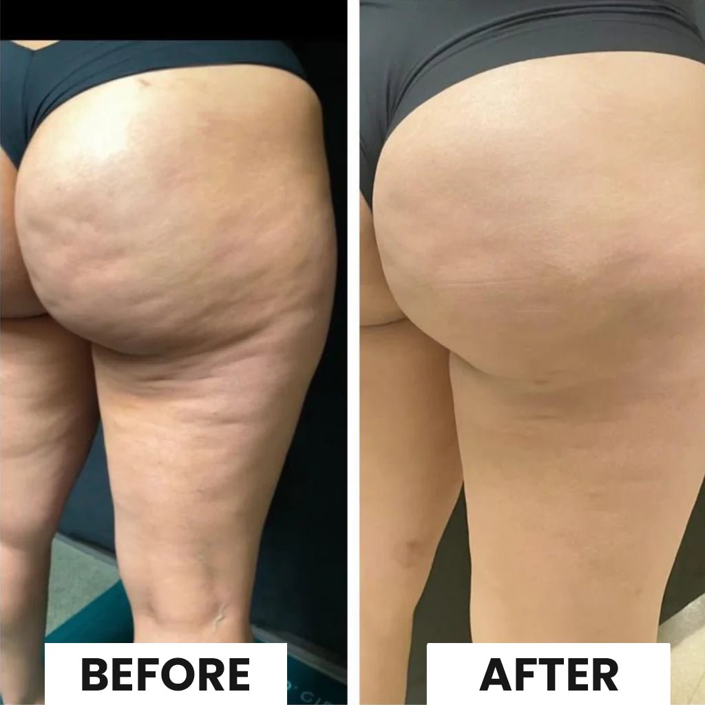 JEREMYTIS™ Cellulite Relief Kit